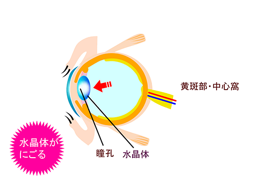 catalact lens
